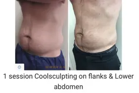 Before and after Coolsculpting treatment Male abdomen by Medical Cosmetic Enhancementsin Washington DC